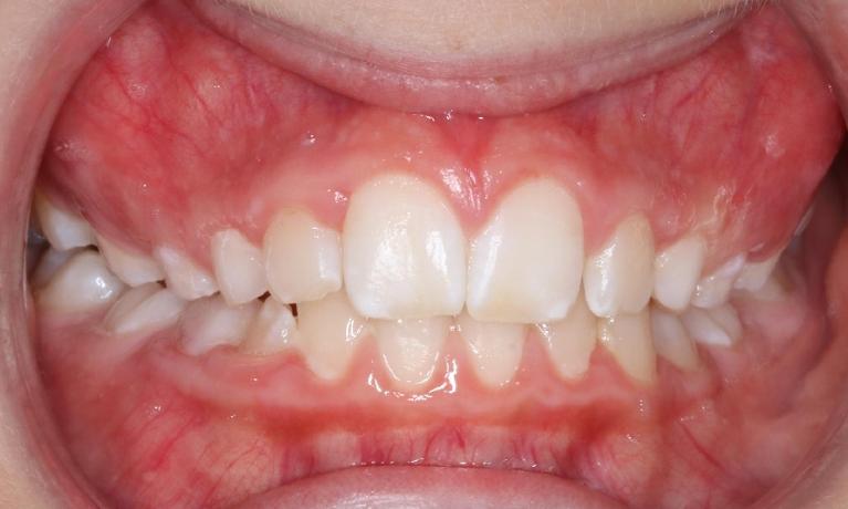 Early-treatment-for-cross-bite-correction-using-a-removable-appliance-After-Image