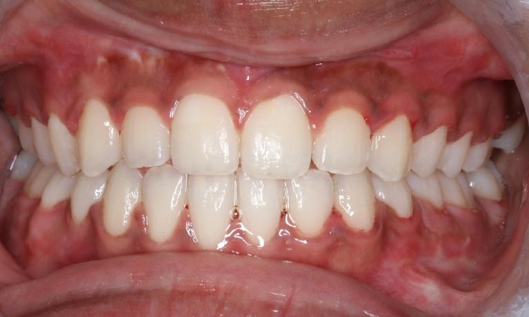 Jaw-asymmetry-managed-with-braces-and-jaw-surgery-After-Image
