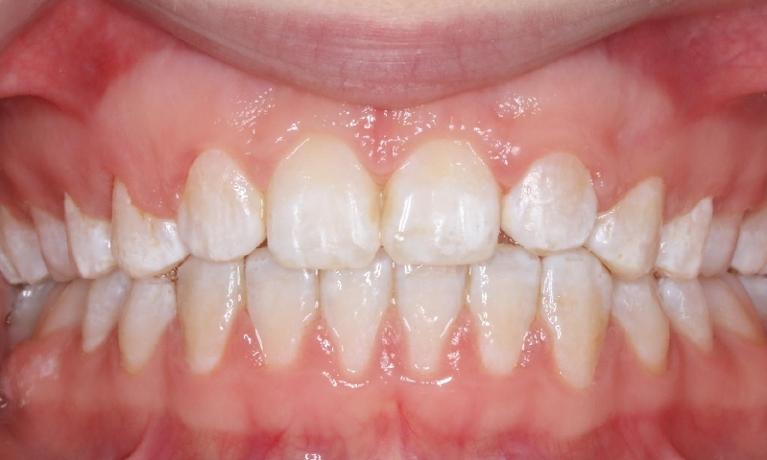 Orthodontics-After-Image