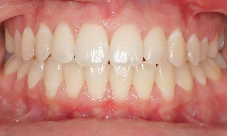 Openbite-correction-clear-aligners-After-Image