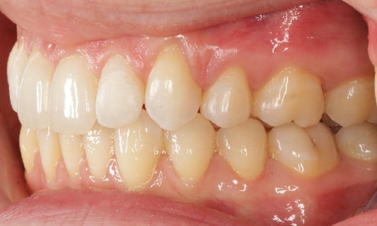 Protruding-teeth-managed-with-extractions-and-clear-aligners-After-Image