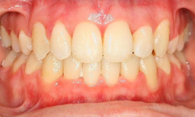 Orthodontics-After-Image