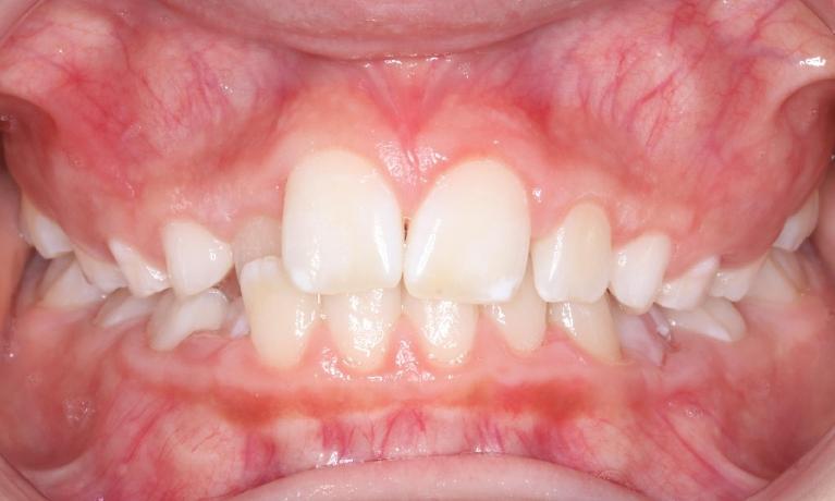 Early-treatment-for-cross-bite-correction-using-a-removable-appliance-Before-Image