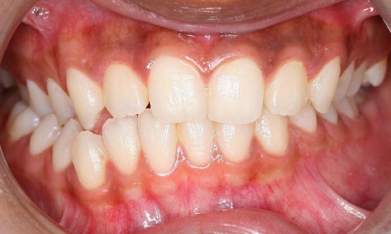Jaw-asymmetry-managed-with-braces-and-jaw-surgery-Before-Image
