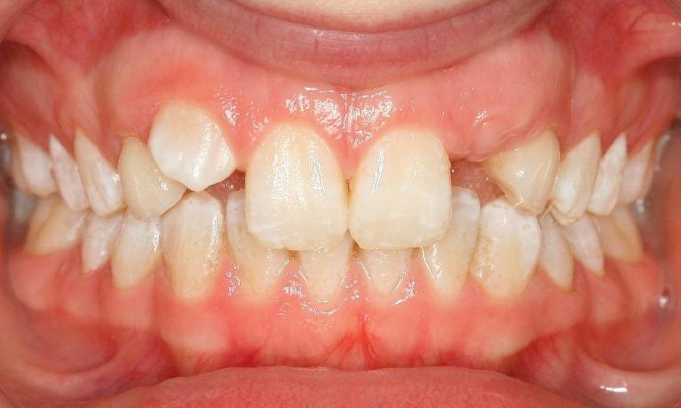 Orthodontics-Before-Image