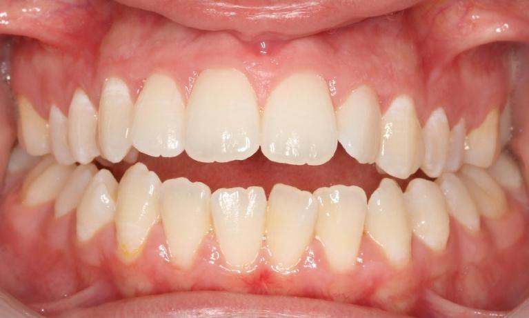 Openbite-correction-clear-aligners-Before-Image
