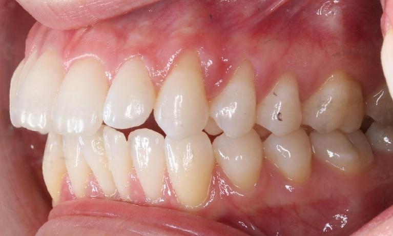 Protruding-teeth-managed-with-extractions-and-clear-aligners-Before-Image