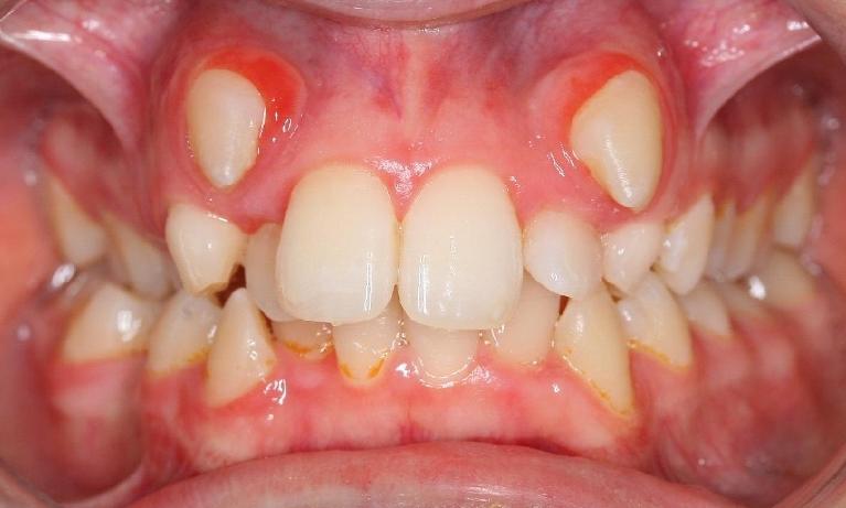 Orthodontics-Before-Image